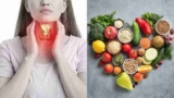 Thyroid-Smart Eating: Everyday Foods People With Thyroid Issues Should Limit